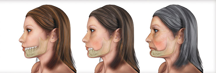 implantes dentales fig 3